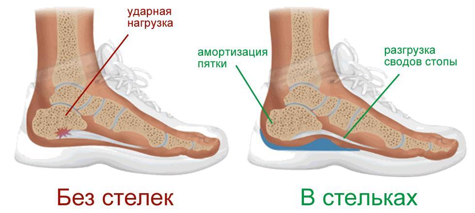 Индивидуальные ортопедические стельки для спортсменов во Владивостоке